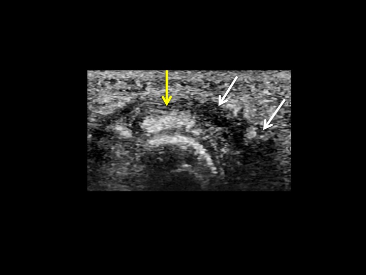 Figure 2 for case plantar plate of metatarsophalangeal joint ( RID3134 )